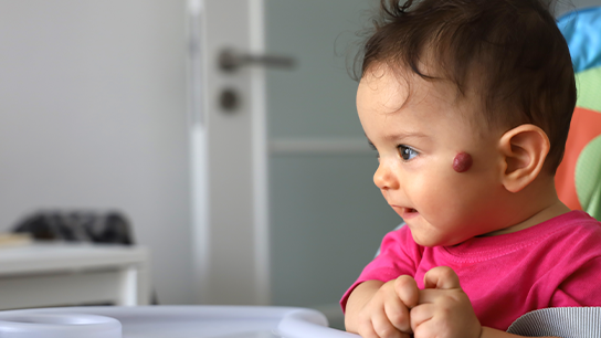 Happy baby has a dime-size hemangioma on left cheek