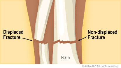 Illustration: Displaced and non-displaced fractures