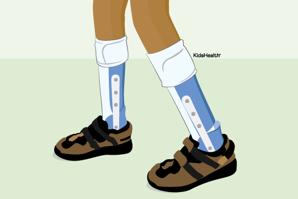 Leg Braces (Orthoses)