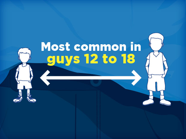 Testicular torsion can happen to guys of any age, but it's most common in teens.

Most of the time there's no obvious cause. Testicular torsion can happen after an injury, during exercise, or even during sleep.