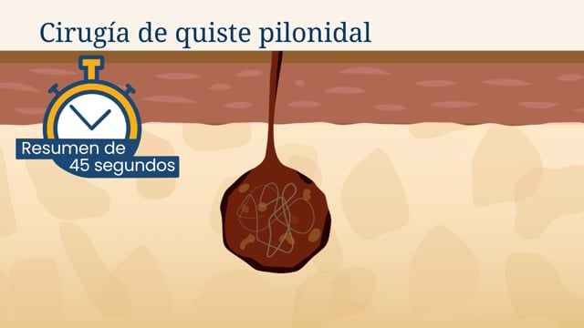 Resumen de 45 segundos: Cirugía de quiste pilonidal