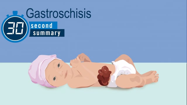 30-Second Summary: Gastroschisis