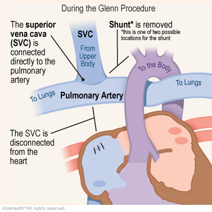 Illustration: During the Glenn Procedure