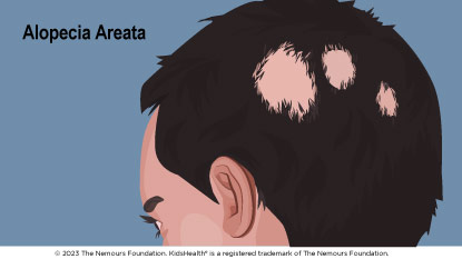 Alopecia areata