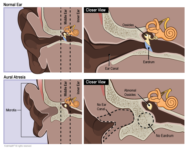 Normal ear compared to aural atresia. Aural atresia ear shows microtia, no ear canal, no eardrum, and abnormal ossicles.