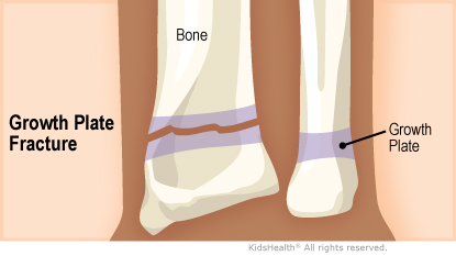 Side-by-side view demonstrating the location of the growth plate and illustrating how a fracture can span across the bone along the growth plate.