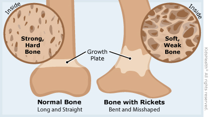 A side-by-side look at a strong, straight bone and a soft, bent bone that's weak because of rickets.