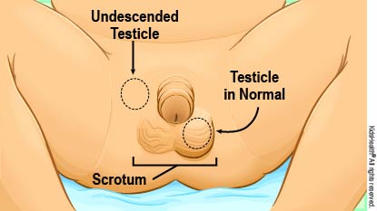 Diagram showing an undescended testicle and the other testicle in the normal position in the scrotum.