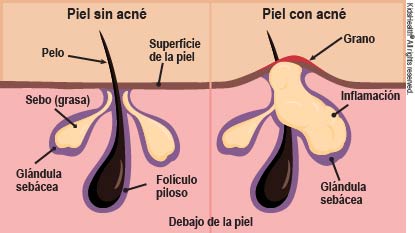 Corte transversal que muestra la diferencia entre la piel con acné y sin acné.