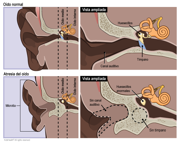 Oído normal comparado con atresia del oído. En un oído con atresia hay microtia, no hay canal auditivo, no hay tímpano y los huesecillos son anormales.