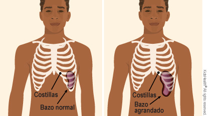 Un bazo normal está completamente cubierto por las costillas. Un bazo agrandado significa que parte del bazo no está protegido por las costillas.